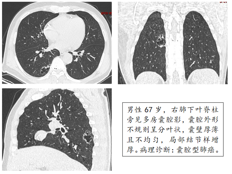 肺癌囊泡2.png